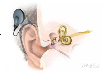 成人耳蜗语言康复视频
